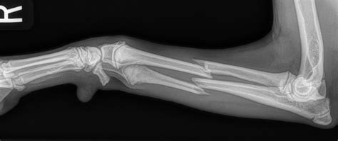 Lateral X-ray image of a dog’s forelimb showing a visible fracture in the radius and ulna, near the midshaft, with clear bone displacement.